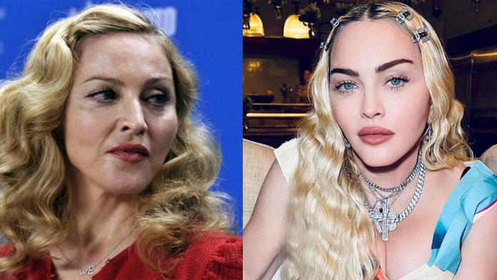 Madonna Before and After Plastic Surgery