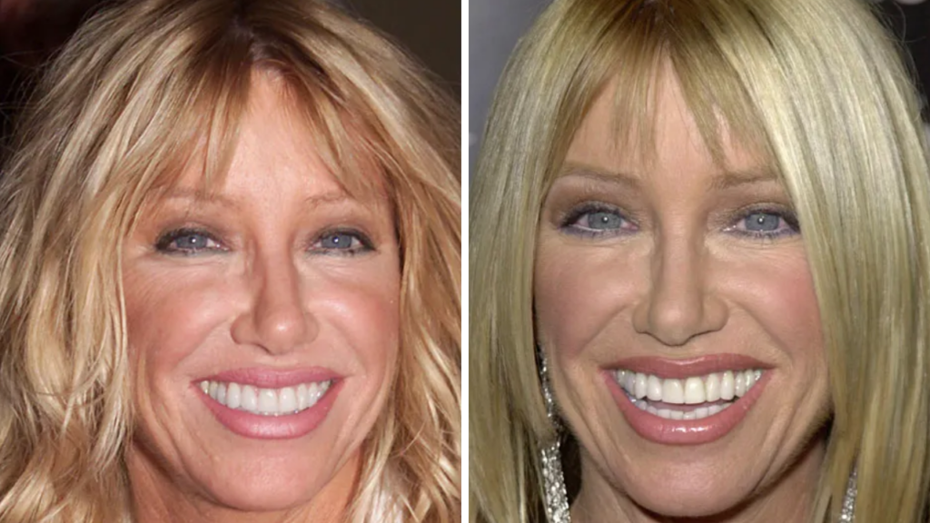 Suzanne Somers Plastic Surgery